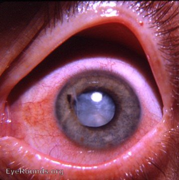 intumescent traumatic cataract with ectropion uveae from 11 to 7 o'clock