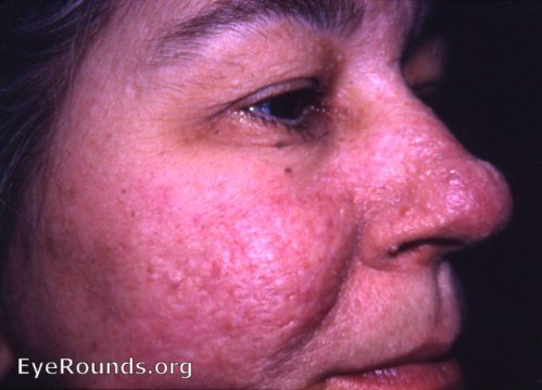 tuberose ( tuberous ) sclerosis: Pringle's Disease/ adenoma sebaceum - left facial view