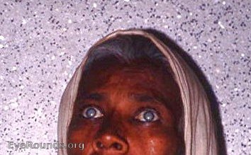 Cataract: bilateral mature senile cataract - typical patient at thEye Clinic in rural India