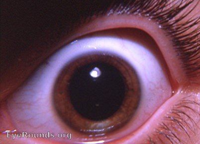 vitiligo of the iris