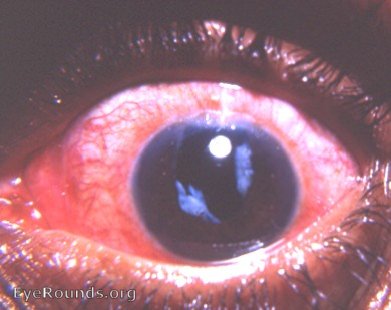 Needled aftercataract