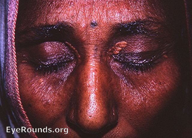 classic xanthelasma - inner upper lid OU