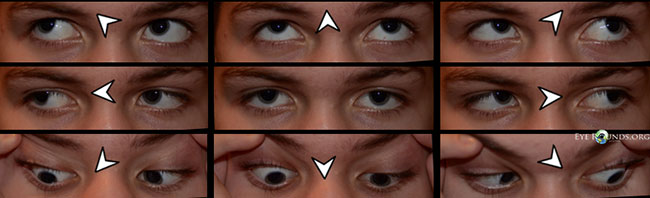 Bilateral 4th Nerve Palsy