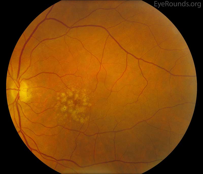 Age-related Macular Degeneration