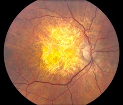 Age-related macular degeneration - advanced