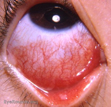 acute mucopurulent bacterial conjunctivitis