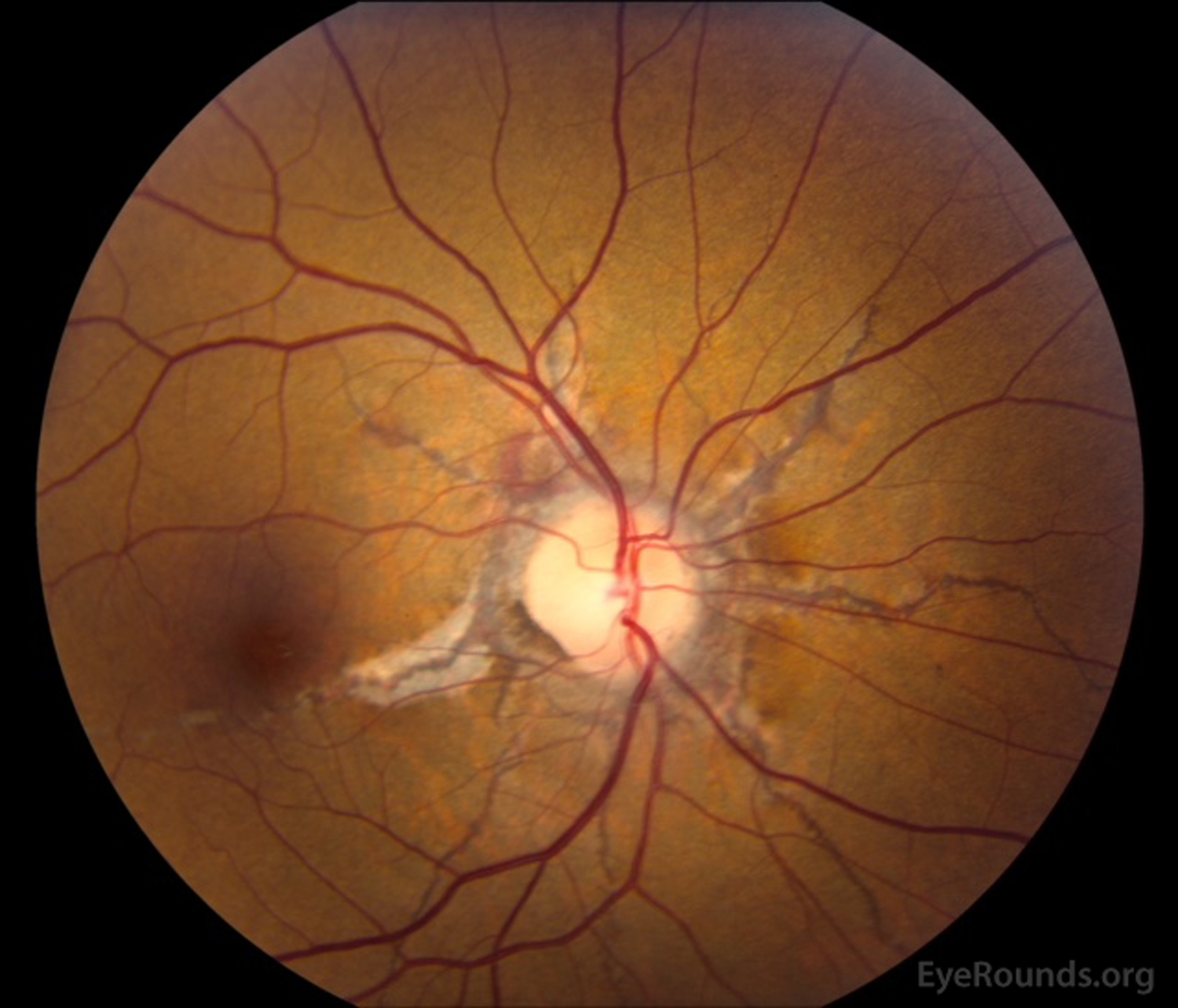 angioid-streaks-and-optic-disc-drusen-in-pseudoxanthoma-elasticum-the