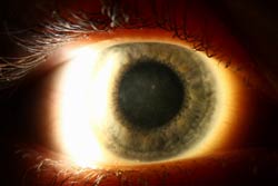 avellino dystrophy