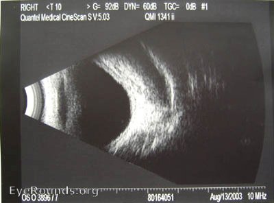 B-Scan echo showing subperiosteal hematoma