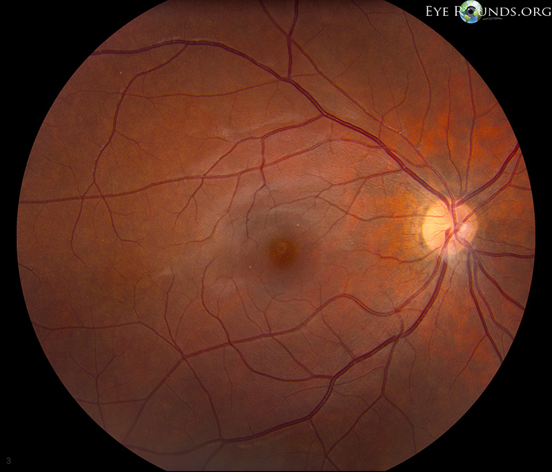 Branch Retinal Artery Occlusion, 1 month later