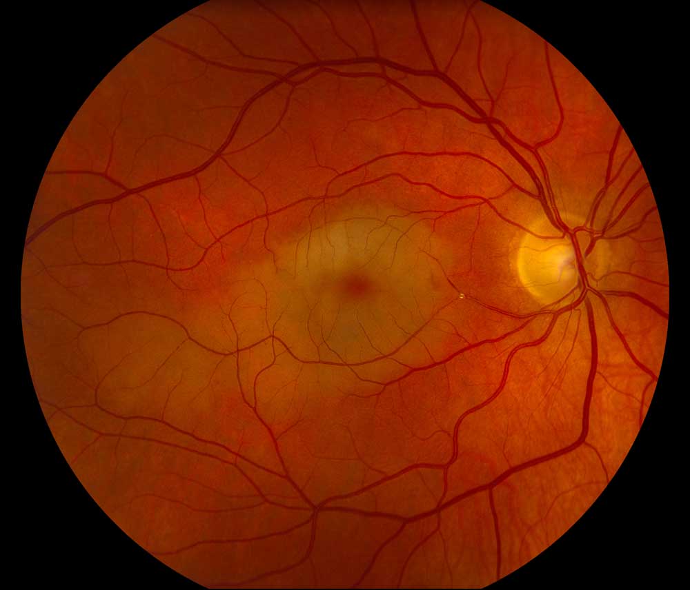 cholesterol (Hollenhorst) plaque became lodged in an inferior branch of the central retinal artery that perfused both the superior and inferior macula