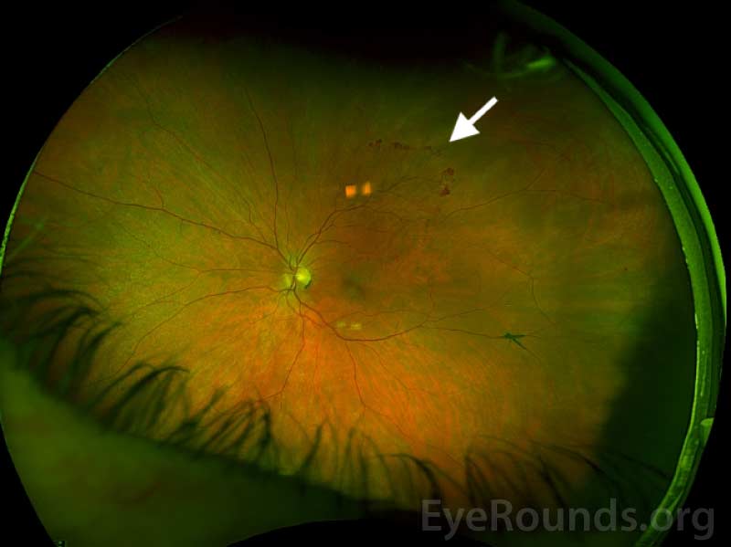 Optos widefield imaging  superior temporal retinal neovascularization elsewhere
