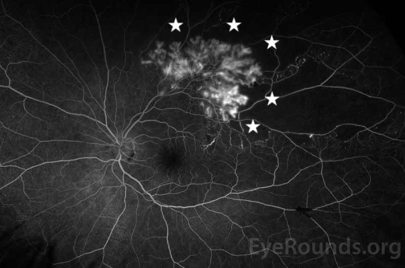 Optos widefield fluorescein angiography during the arteriovenous phase demonstrates neovascularization with mild leakage