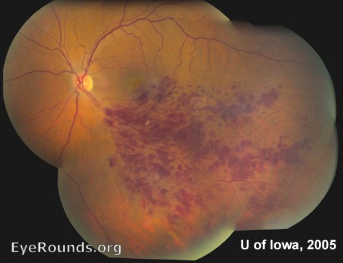 Branched Retinal Vein Occlusion