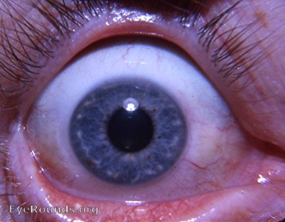normal variant in iris anatomy in a healthy adult