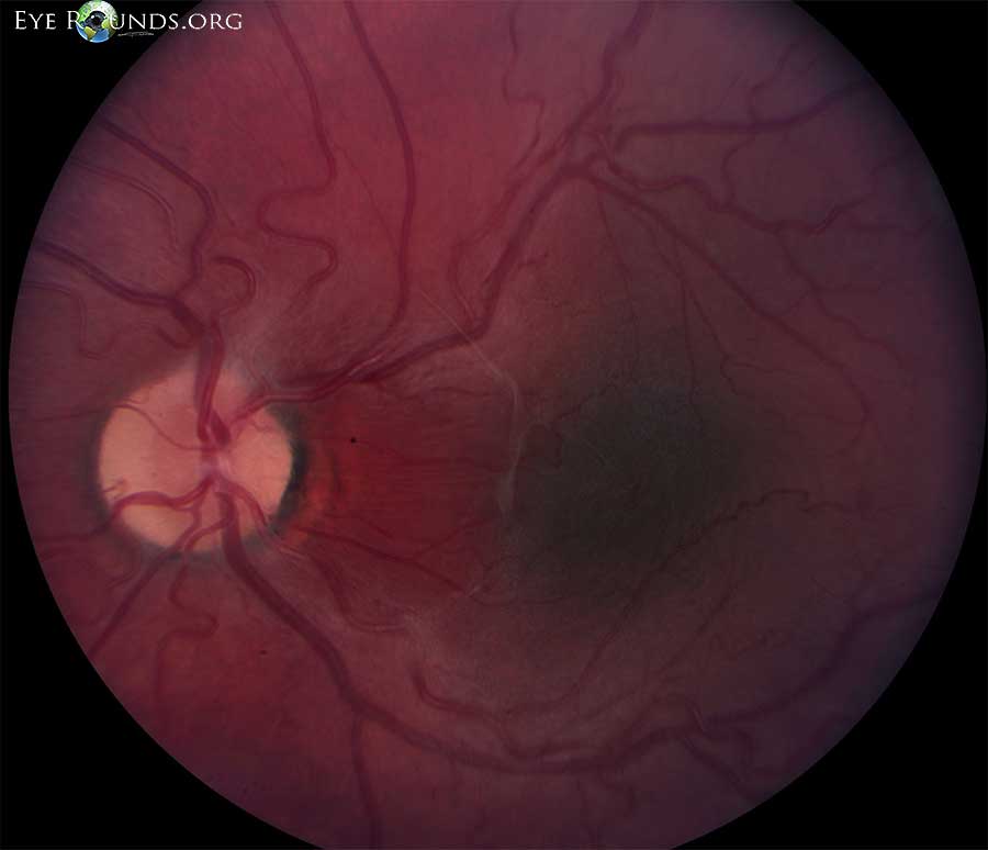 a 5 x 5 x 1 mm area of slightly elevated retinal pigment epithelium (RPE) pigmentation with a surrounding area of more orange appearing RPE
