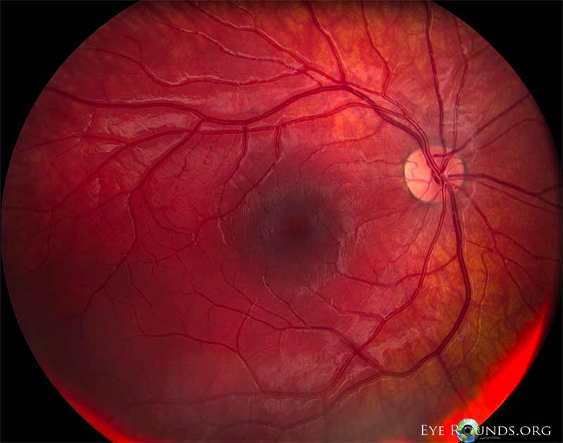Dilated fundus examination OD revealed a small cup with a cilioretinal artery. The discs, macula, vessels and periphery were normal. 