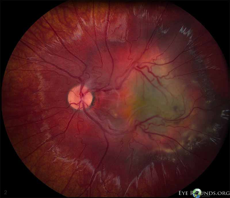 pigmented macular lesion appeared approximately the same size as was noted previously, but the surrounding orange colored ring appeared considerably more prominent. The retinal blood vessels were still dilated and tortuous