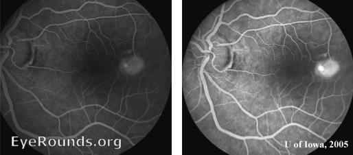 flourescein angiogram demonstrate a hot spot of hyperflourescence that spreads to fill the PED
