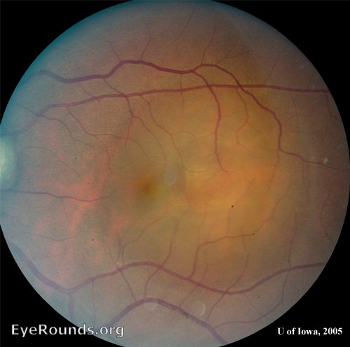  elevated area of serous retinal detachment can be seen occupying much of the temporal macula