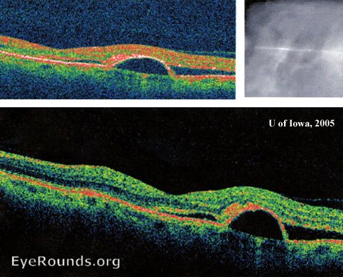 OCT images demonstrate a discrete blister of fluid underneath the RPE just temporal to the foveal depression