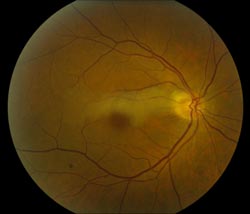 cilioretinal artery occlusion