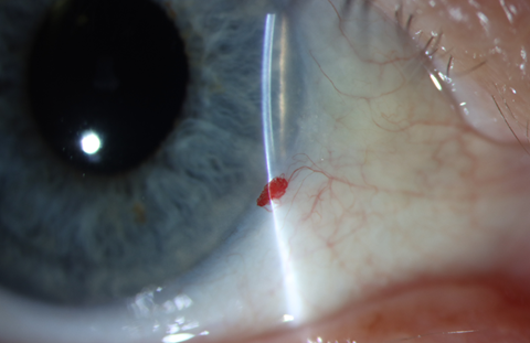 Dilated funduscopic examination showed severe, diffuse optic atrophy OD and bow-tie (band) optic atrophy OS