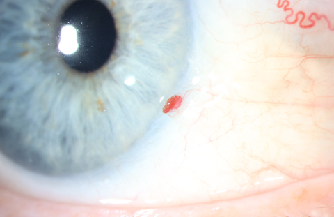 Dilated funduscopic examination showed severe, diffuse optic atrophy OD and bow-tie (band) optic atrophy OS