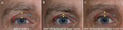 Cosmetic Correction of Secondary Upper Eyelid Dermatochalasis After Upper Eyelid Ptosis Surgery