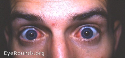 episcleritis - bilateral - in a scholastic with ulcerative colitis