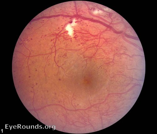 Seen are neovascularization, cotton wool spots, microaneurysms, and intraretinal hemorrhages.