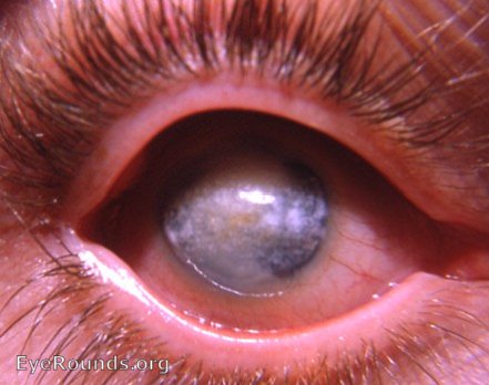 diffuse calcareous keratopathy