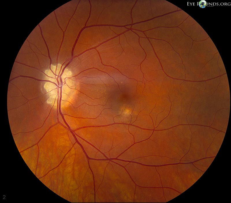 Case Reports. EyeRounds.org - Ophthalmology - The University of Iowa