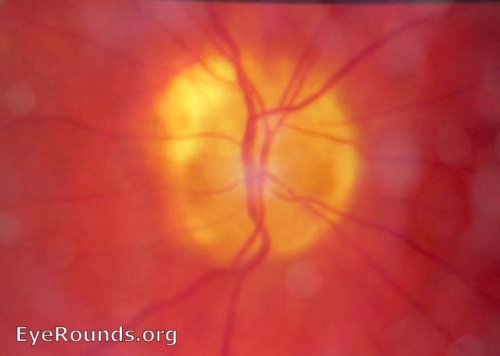 Refractile drusen seen in optic nerve.