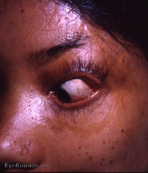 Cicatricial ectropin from burns sustained by Nepalese girl