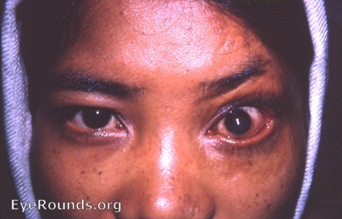 ectropion of lids OS from scarring due to lid burns