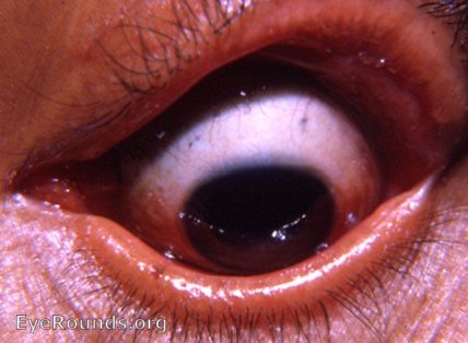 Ectropion-right upper lid from burn- see other Atlas photos of this Nepalese patient.