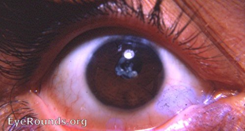 Cataract: post-needling Elschnig's pearls