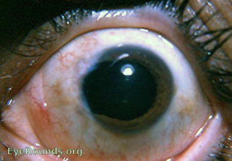 Post-excision of huge prolapsed iris following intracapsular cataract ...