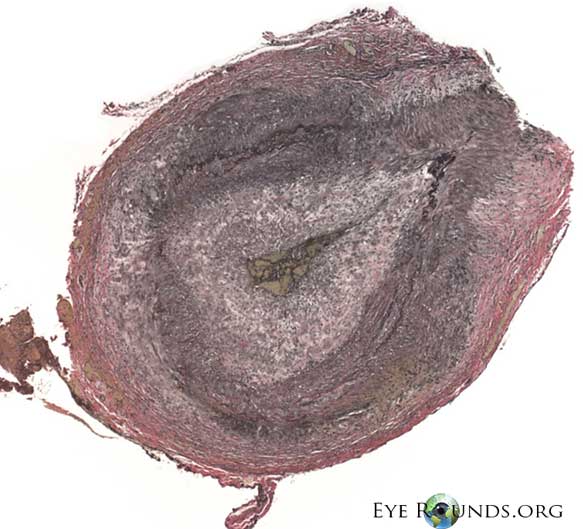 Giant Cell arteristis Verhoeff-Van Gieson stain shows disruption of the internal elastic lamina.