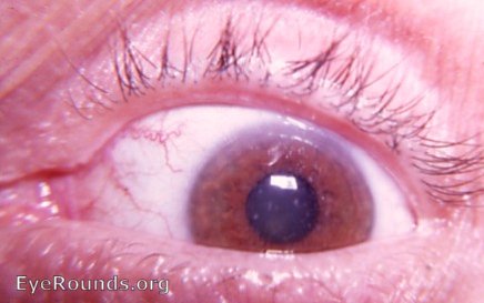 Groenouw's Type I Granular corneal dystrophy
