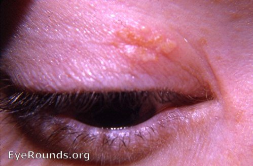 herpes simplex I of the lid