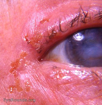 herpes simplex I of the lid