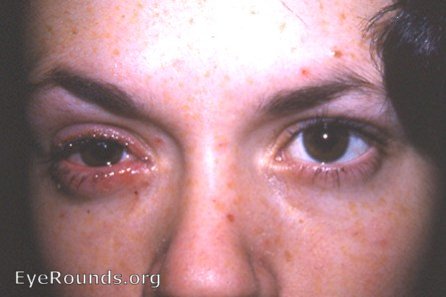 herpes simplex I of the lid