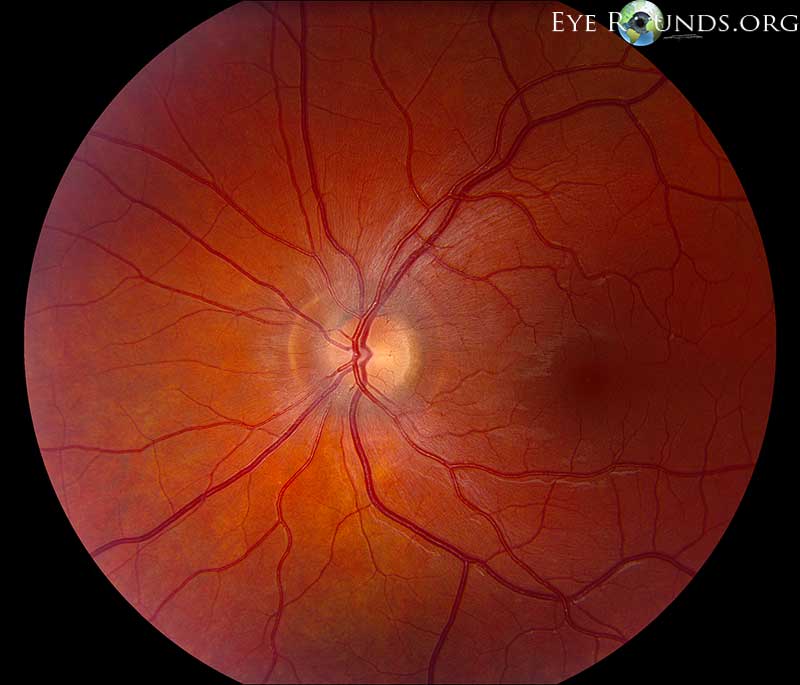 High water mark after optic nerve head edema