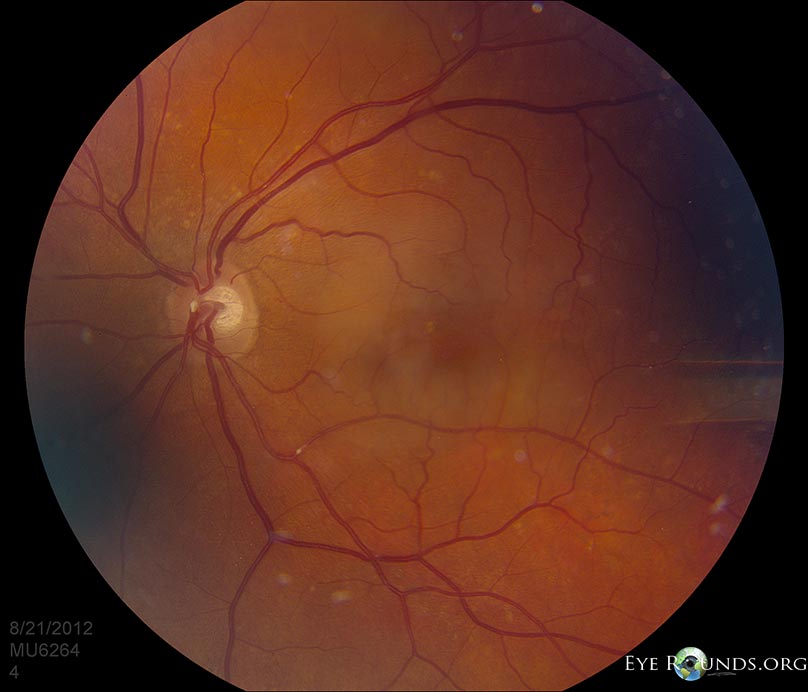 Atlas Entry Hollenhorst Plaque In Branch Retinal Artery Occlusion BRAO Atlas Entry Hollenhorst Plaque In Branch Retinal Artery Occlusion BRAO