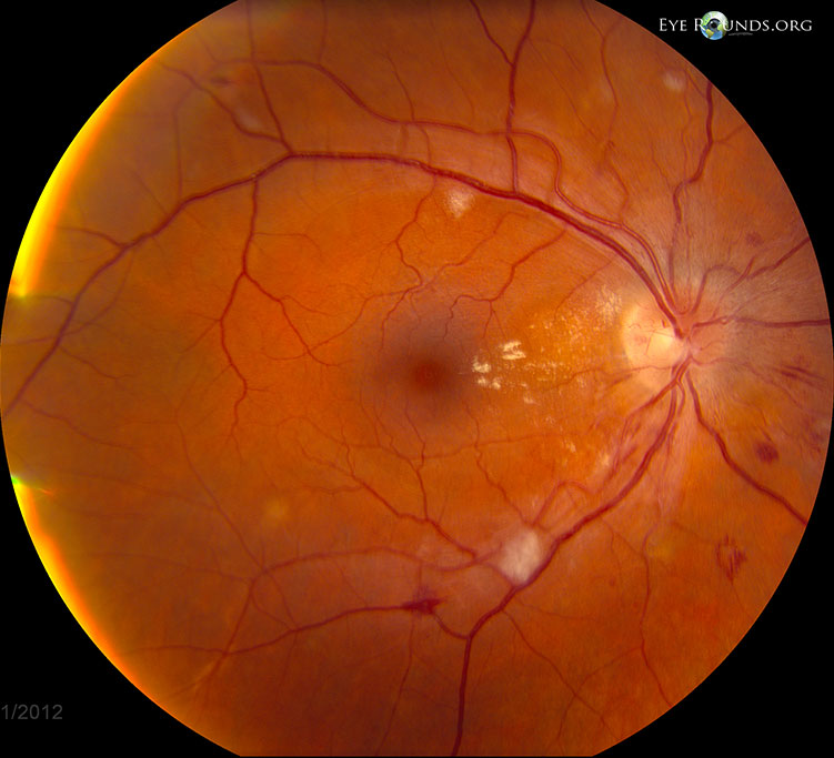 two fundus images showing Hypertensive retinopathy: 37-year-old male with optic disc edema, cotton wool spots, flame hemorrhages, dot blot hemorrhages, arteriovenous nicking, and exudates