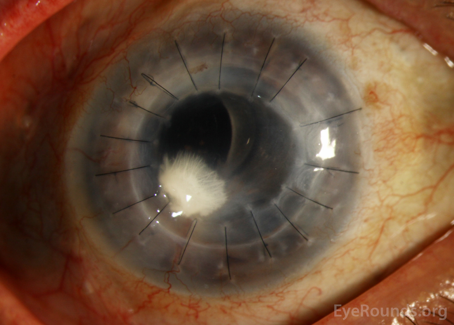 Slit lamp photograph of the right eye shows mild injection, penetrating keratoplasty graft