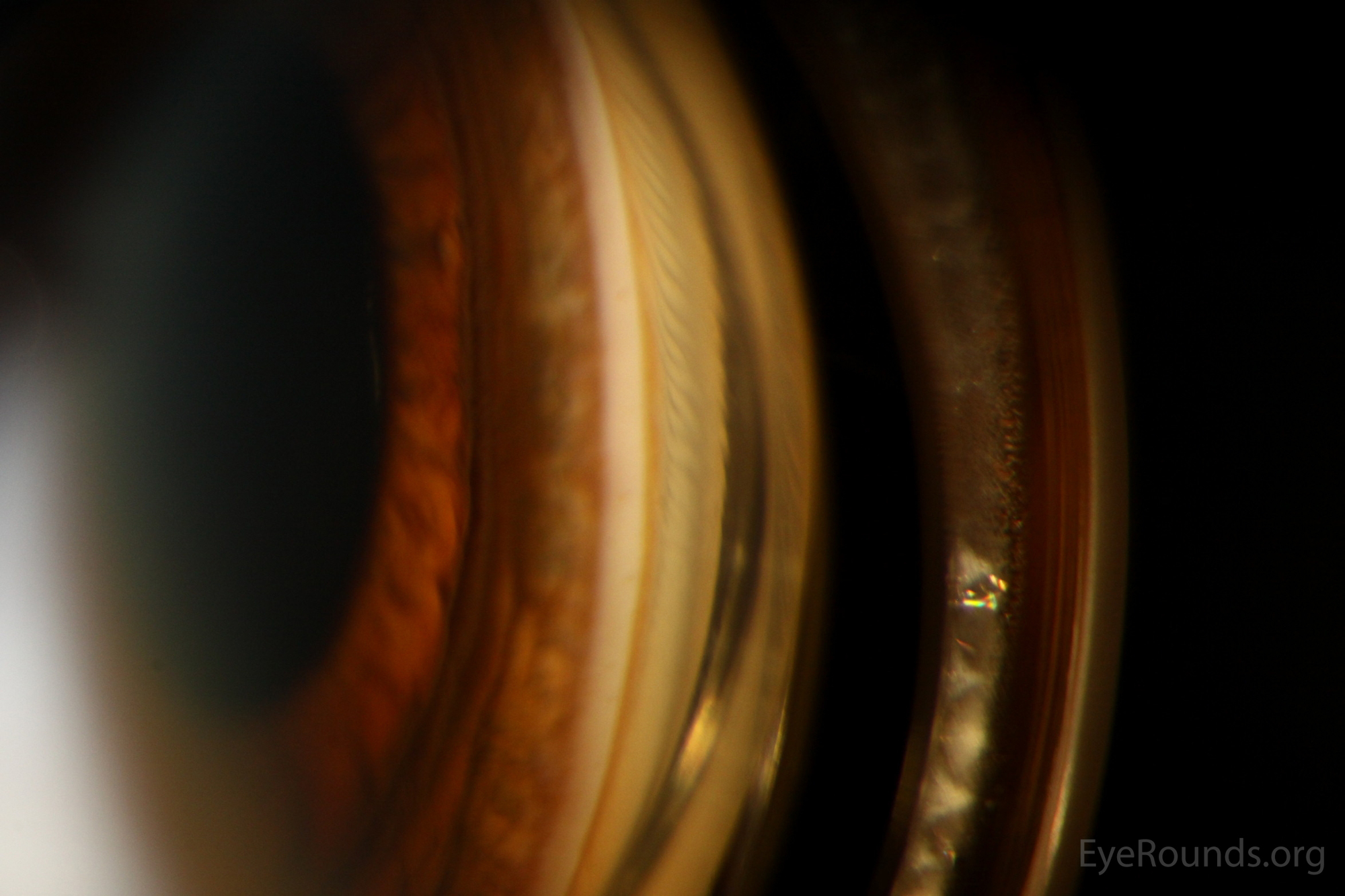  Slit lamp gonioscopy photographs of a Kayser-Fleischer ring