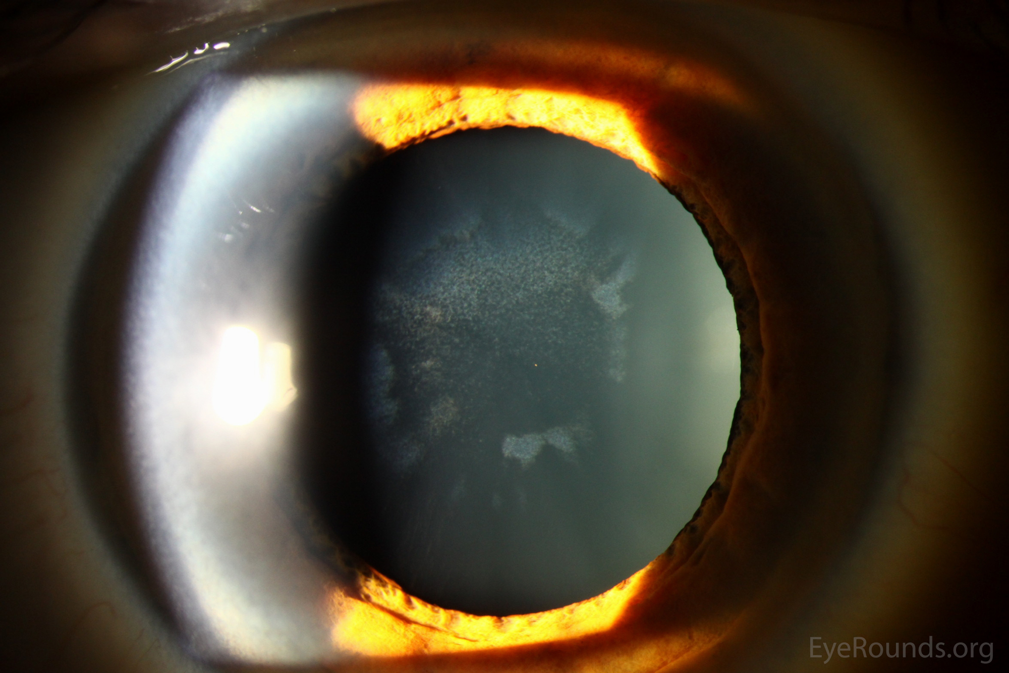 Slit lamp photographs of sunflower cataracts of the right eye